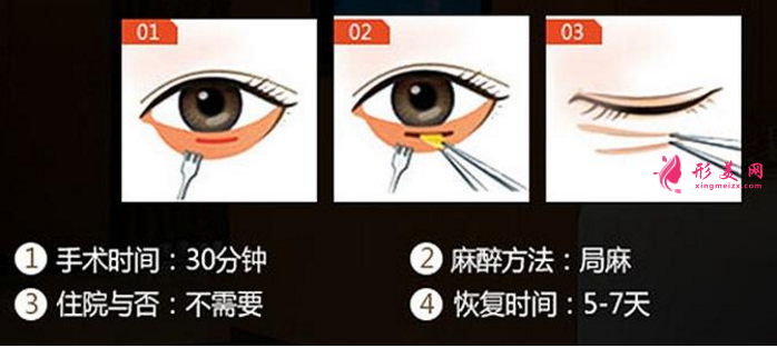 北京祛眼袋多少錢？術(shù)后恢復(fù)時(shí)間和護(hù)理掛鉤~