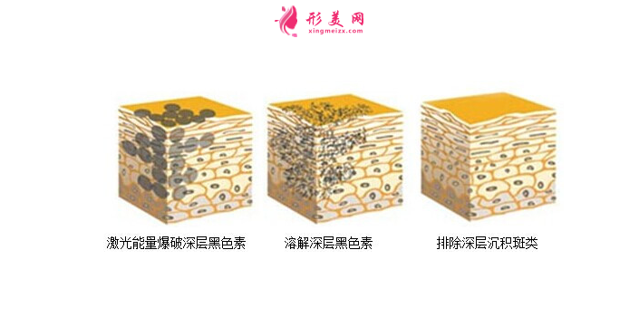 術(shù)前科普：激光祛斑多少錢一次？