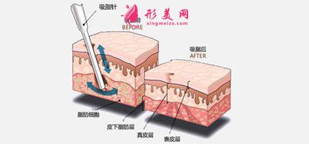 手臂吸脂術(shù)安全嗎？吸脂一次多少錢？