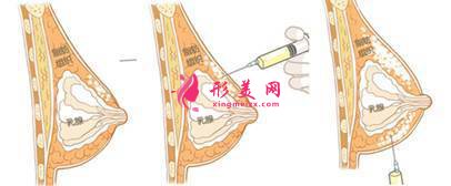 自體脂肪隆胸好嗎？術(shù)前準(zhǔn)備工作要知道！