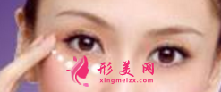 手術(shù)切除眼袋后疼不疼