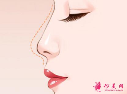 假體隆鼻多久鼻子不發(fā)紅