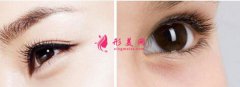 割雙眼皮傷口癢正常嗎？