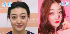 北京畫美整形醫(yī)院除皺瘦臉效果怎么樣？案例分享