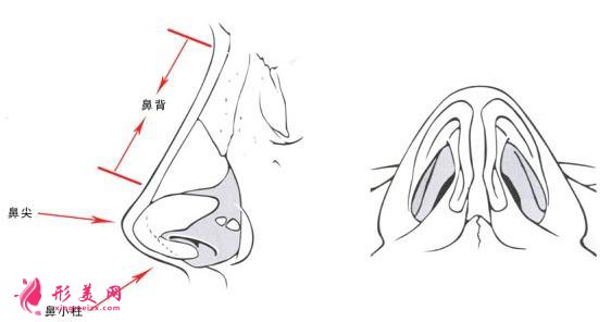 假體隆鼻的后遺癥