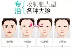鄭州整形醫(yī)院打瘦臉針效果怎么樣？瘦臉針價格~