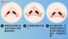 鼻翼整容術(shù)能收縮鼻翼嗎？