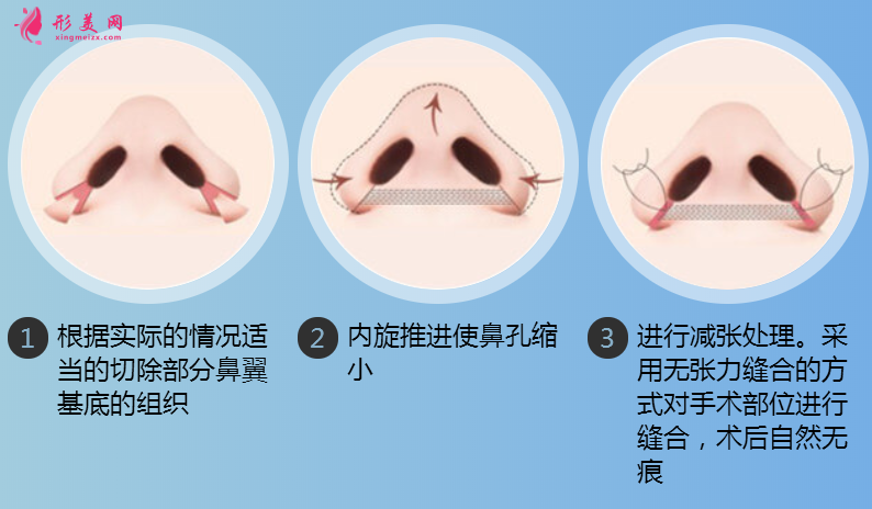 鼻翼整容術(shù)能收縮鼻翼嗎