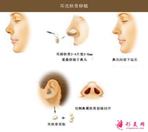 硅膠墊鼻梁維多少年