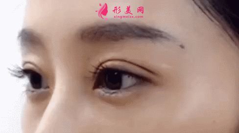 一般做雙眼皮手術(shù)多少錢