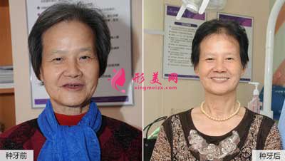徐濤醫(yī)生種植牙真人案例分享