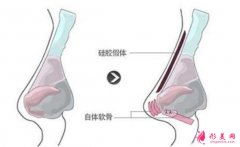 【術(shù)前科普】硅膠墊鼻梁多久要取出來？