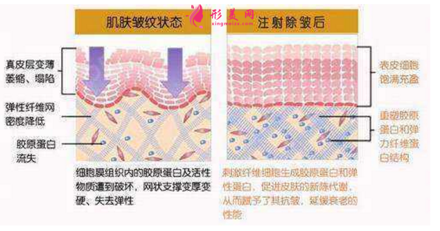 注射除皺效果怎么樣？附術(shù)前術(shù)后注意事項(xiàng)！