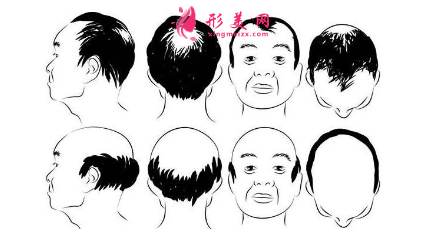 頭發(fā)種植效果可靠嗎？術(shù)前注意事項(xiàng)大全！
