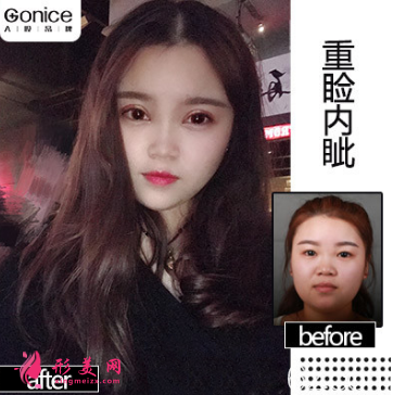 西安高一生雙眼皮案例