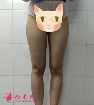 鄭大二附院整形科劉月麗抽脂怎么樣？大腿抽脂案例來查看！