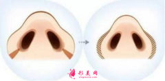 上海整形醫(yī)院做鼻翼縮小痛不痛？