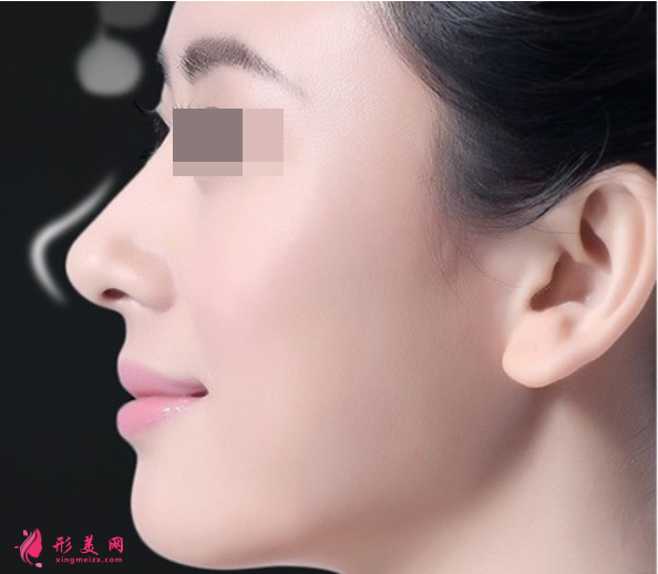 肋軟骨隆鼻切口會有明顯疤痕嗎