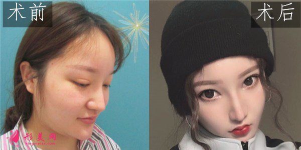 深圳顏美醫(yī)療美容門診部吸脂案例