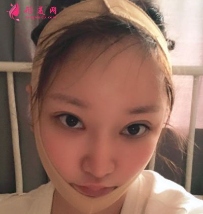 深圳顏美醫(yī)療美容門診部吸脂案例