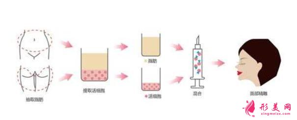 做自體脂肪隆鼻可能會變寬嗎?危害什么