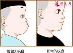 兜齒矯正的最佳年齡是多少歲?