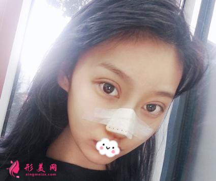 整形初體驗(yàn)：假體隆鼻后整理的隆鼻經(jīng)驗(yàn)分享給大家【附圖】