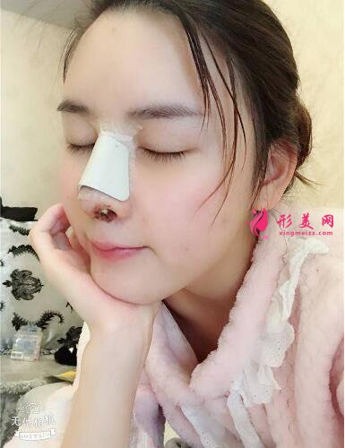 北京哪家隆鼻好？我找藝星仇侃敏做了隆鼻后的效果圖