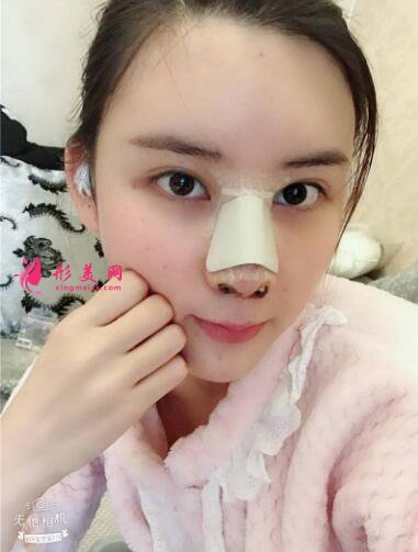 北京哪家隆鼻好？我找藝星仇侃敏做了隆鼻后的效果圖