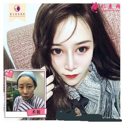 由王高峰完成的眼部合成+鼻部合成隆鼻+自體脂肪面部填充的案例