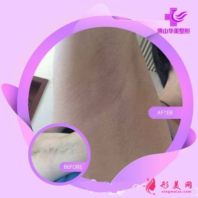 佛山華美醫(yī)療整形美容醫(yī)院脫毛案例研究