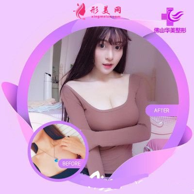 佛山華美整形美容醫(yī)院假體隆胸病例比較