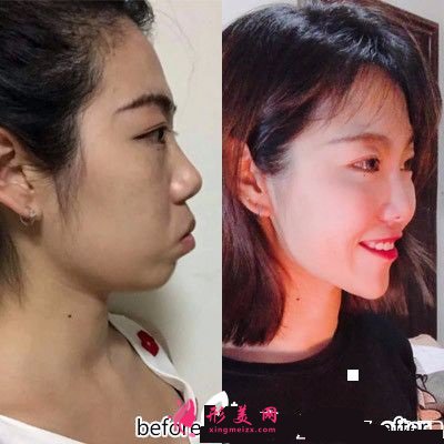 深圳美萊口腔醫(yī)院陶瓷隱形牙齒矯正案例