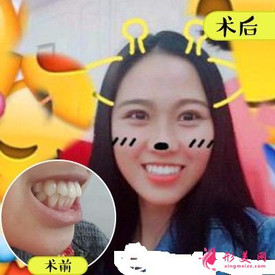 深圳美萊口腔醫(yī)院金屬托槽牙齒矯正案例