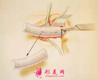 自體軟骨隆鼻后會(huì)鈣化嗎