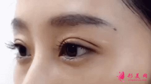 雙眼皮效果不滿意多久修復(fù)比較好