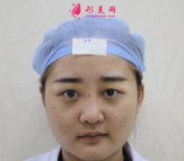 北京大學(xué)人民醫(yī)院整形科雙眼皮效果曝光!前后對比效果很自然