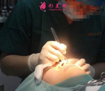 上海伯思立徐曉菲雙眼皮案例怎么樣?醫(yī)生手術(shù)恢復效果一覽