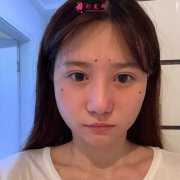 面部脂肪填充手術(shù)真實(shí)恢復(fù)過程，記錄美好生活