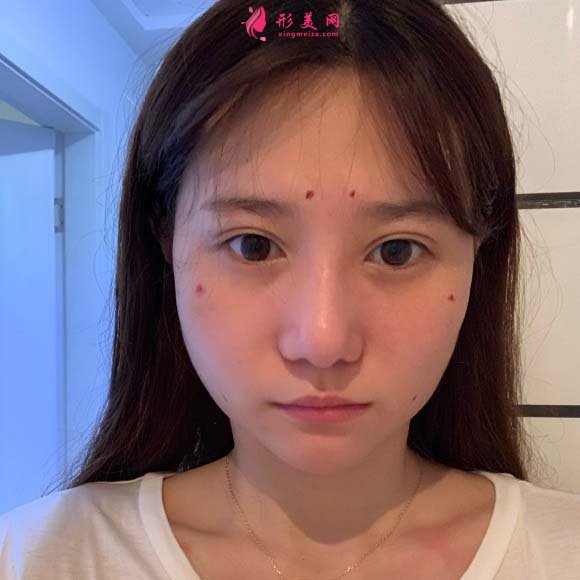 面部脂肪填充手術(shù)真實(shí)恢復(fù)過程，記錄美好生活