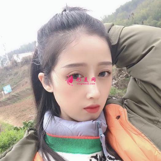 膨體隆鼻