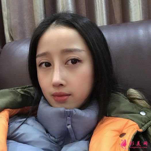 自體軟骨隆鼻