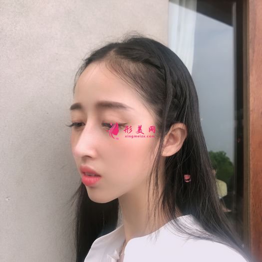 做完膨體隆鼻和自體軟骨隆鼻后，鼻子挺了很多