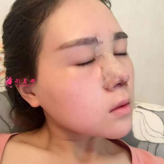 做自體肋軟骨和膨體綜合隆鼻后感受