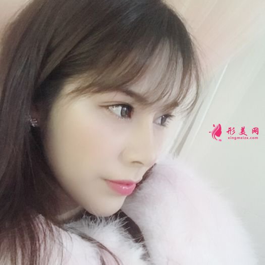 肋軟骨鼻綜合之后自拍美美噠