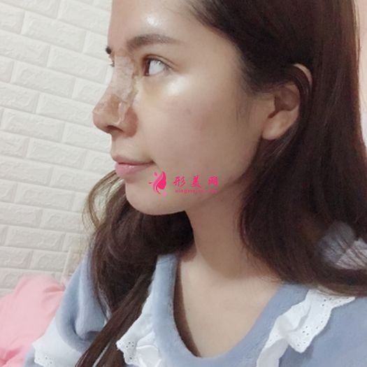 肋軟骨鼻綜合之后自拍美美噠