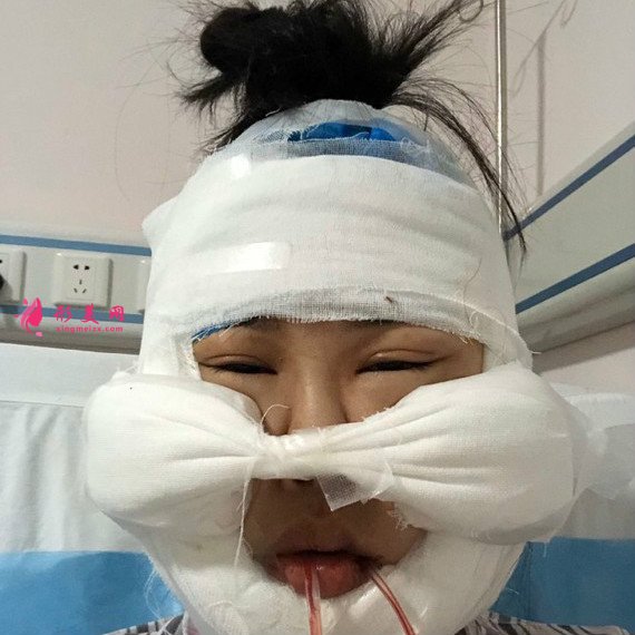 廣州下頜角整形+顴骨顴弓降低+咬肌縮小手術(shù)過(guò)程恢復(fù)分享