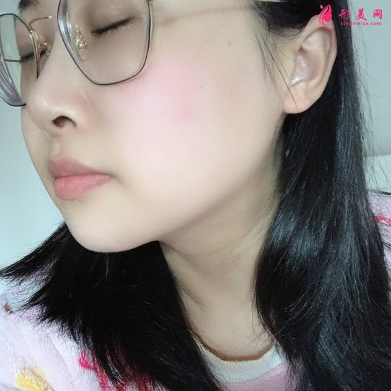 廣州下頜角整形+顴骨顴弓降低+咬肌縮小手術(shù)過(guò)程恢復(fù)分享