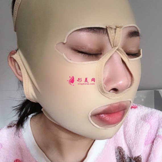 廣州下頜角整形+顴骨顴弓降低+咬肌縮小手術(shù)過(guò)程恢復(fù)分享