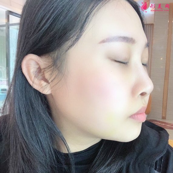 廣州下頜角整形+顴骨顴弓降低+咬肌縮小手術(shù)過(guò)程恢復(fù)分享